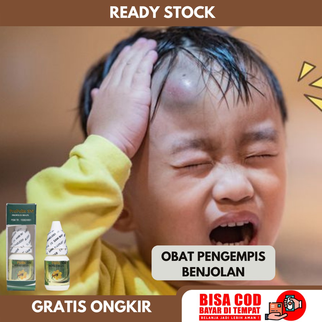 Obat Penghilang Benjolan, Benjolan di Dahi, Benjolan di Jidat, Pengempis Benjolan di Kepala Anak dan