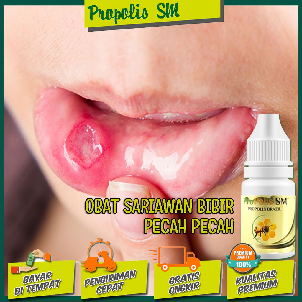 Obat Sariawan Bibir Pecah Pecah - Sariawan Akut - Sariawan Kronis - Sariawan Menahun Propolis SM