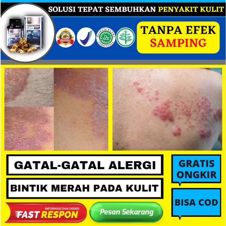 Jual Obat Untuk Gatal Gatal Bentol Alergi Infeksi Kulit Kemerahan Bintik Bintik Merah Di Tangan