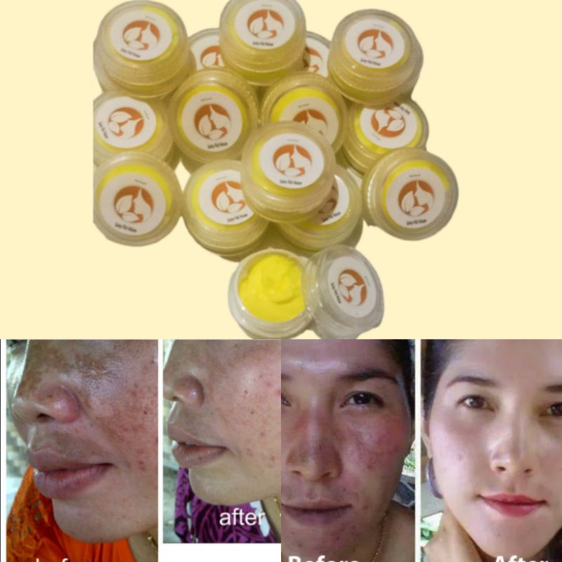 Salep Flek Glowing Super/Salep Flek Klinik/Salep Melasma