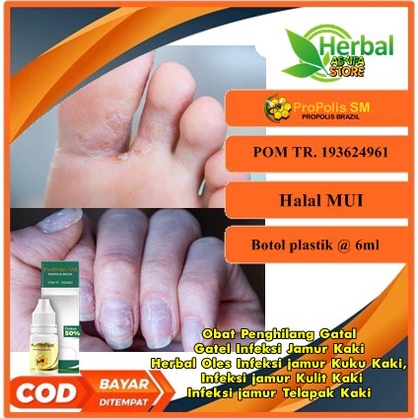 Obat Penghilang Gatal Gatel Infeksi Jamur Kaki | Herbal Oles Infeksi jamur Kuku Kaki, Infeksi jamur 