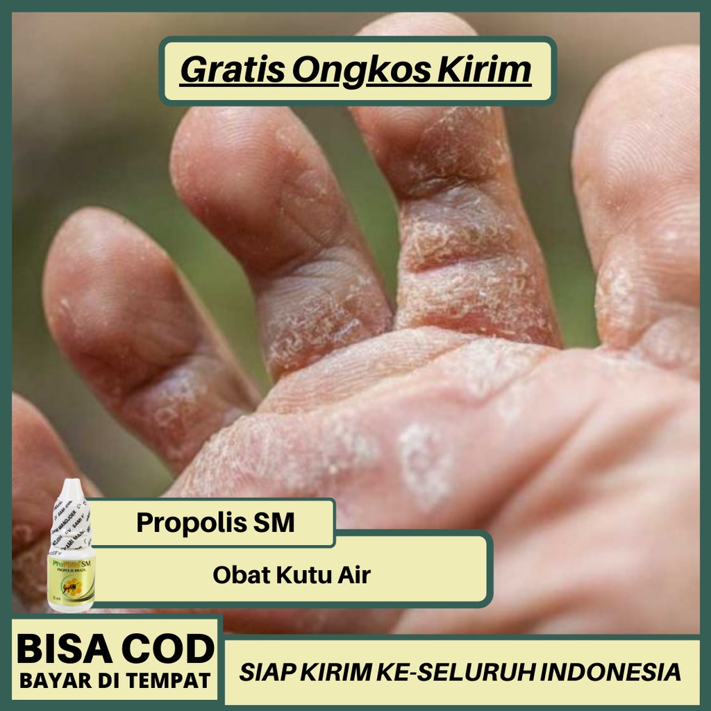 Obat Kutu Air Di Telapak Kaki Homecare24 7836