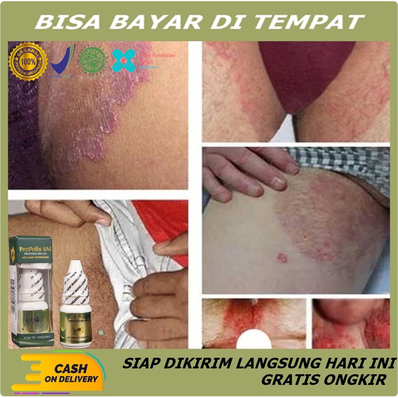 Obat Oles Selangkangan Hitam/Gatal - Obat Tinea Cruris Rasa Gatal di Selakangan Akibat Infeksi Jamur