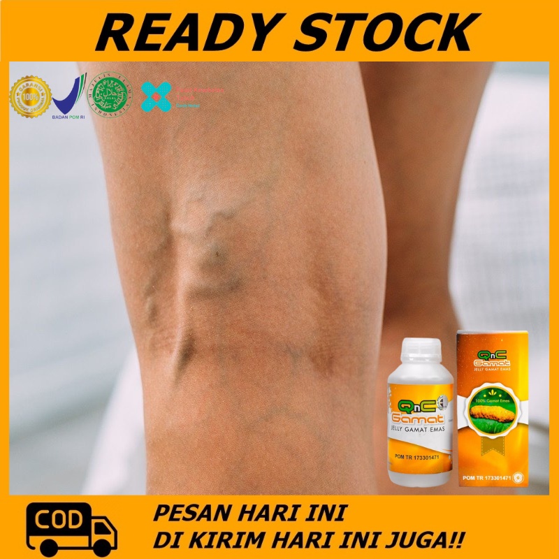 Obat Penghilang Varises, Obat Urat Menonjol, Obat Urat Tangan Menonjol, Obat varises di betis, Obat 
