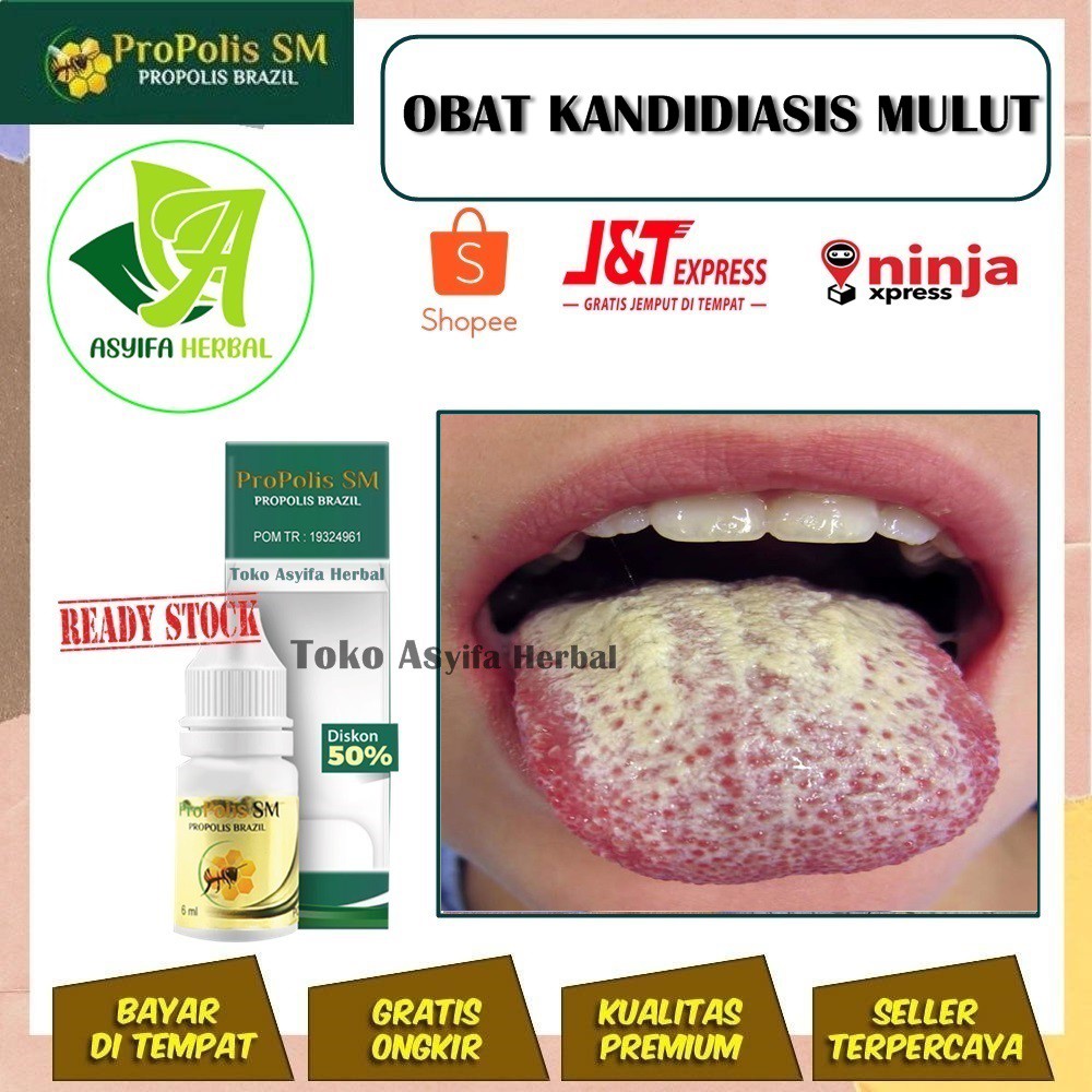 Jual Obat Kandidiasis Mulut 100 Herbal Bintik Putih Di Lidah Sakit Tenggorokan Sakit Menelan 6215