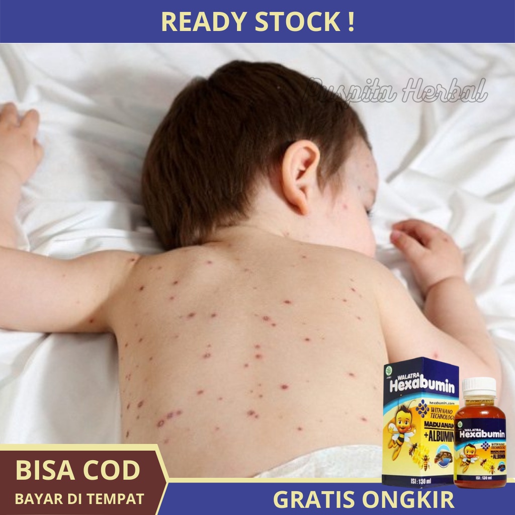 Obat Gatal-Gatal Pada Anak Asli, Obat bintik merah dibadan, korengan pada anak, alergi pada anak, ir
