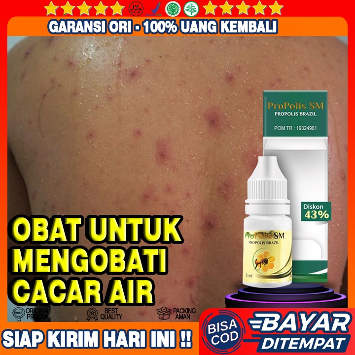 Obat Cacar Air, Penghilang Bekas Cacar,  Campak, Penghilang Bekas Luka