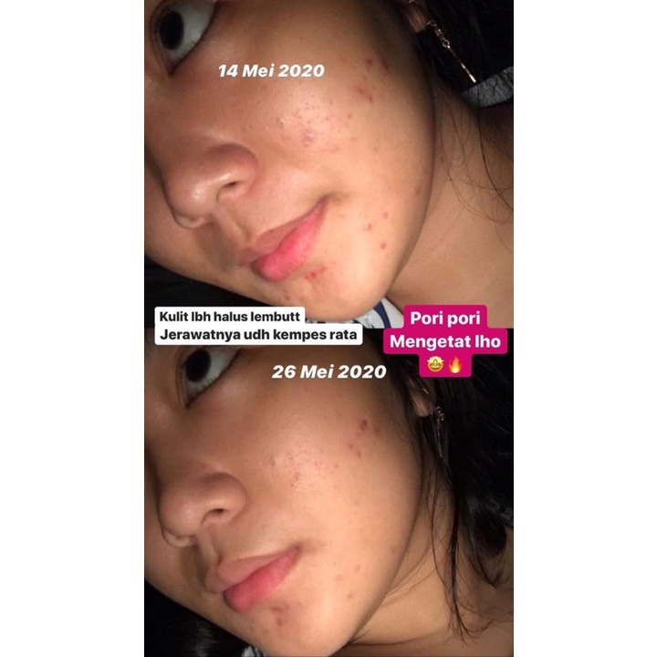 (New FORMULA)ORI!! KALEY Pineapple-c Lightening Essence Serum Nanas vitamin c acne perawatan wajah-2