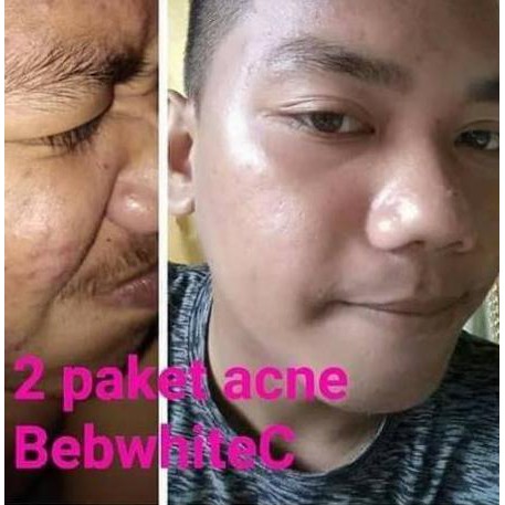● (BISA  )BEBWHITE C SKINCARE / PAKET ACNE BBC / ORI / SKINCARE PENGHILANG JERAWAT ✬