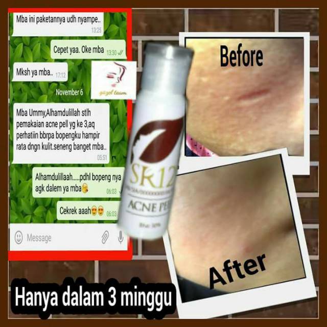 ACNE PEEL BHA30% / ATASI BOPENG / MENGANGKAT KOMEDO MENGURANGI BEKAS JERAWAT &amp; BRUNTUS