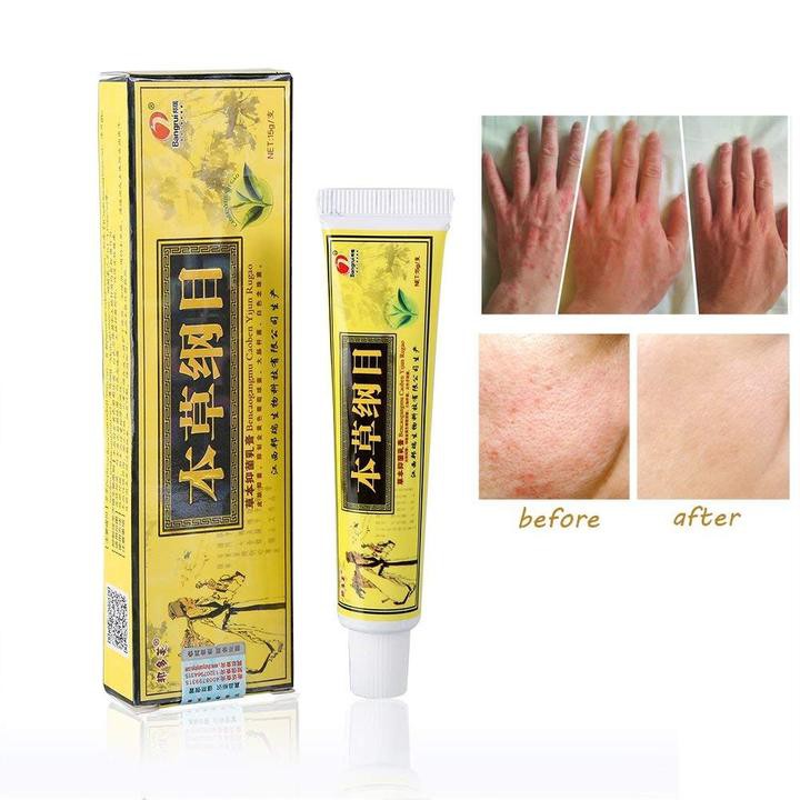 Cream Eksim Kulit Gatal  Psoriasis Jerawat Ruam Jamur Kudis Kurap Kutu Air Obat Kulit Gatal Anti bakteri Anti Gatal Krim Kulit Psoriasis Dermatitis Eksim (SALEP KUNING) 15g