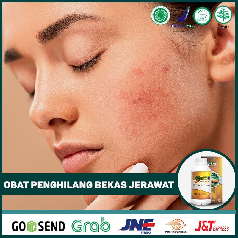 Obat Penghilang Bekas Jerawat, Bopeng, Syringoma, Muka Milia QnC Jelly Gamat Asli Di Surabaya