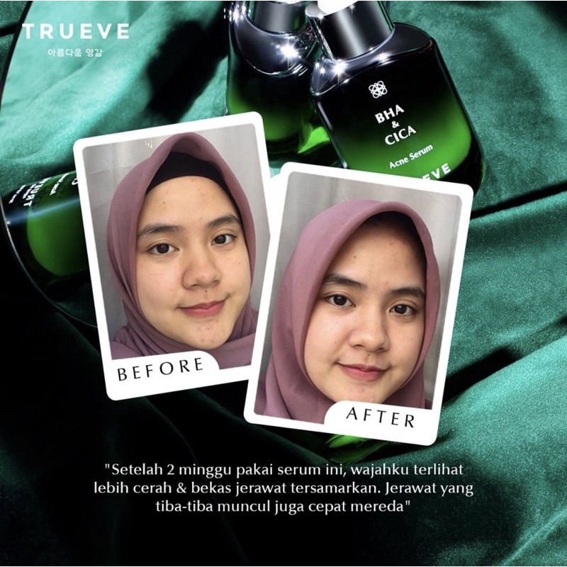 TRUEVE Acne Care Treatment Serum 30 ML (Serum Jerawat, Obat Jerawat, Serum Jerawat dan bekasnya)