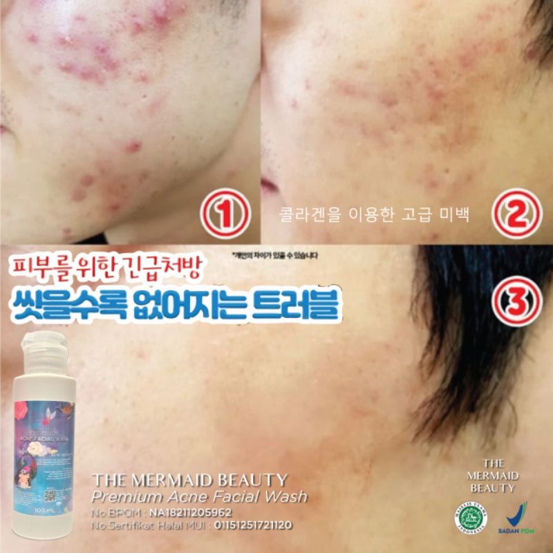🇰🇷BPOM Premium Acne Facial Wash Dr Korea