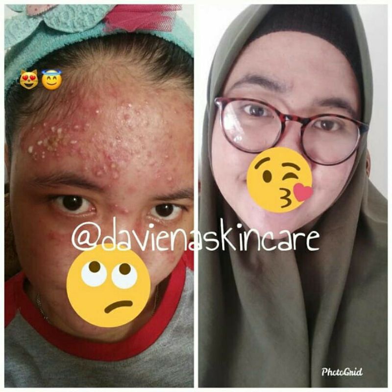 Daviena Skincare Paket Acne Series Davienaskincareofficial Davina Devina Lampung Surabaya Jakarta Jerawat Pencerah Pemutih Wajah Glowing Bpom Daviena Skincare-6