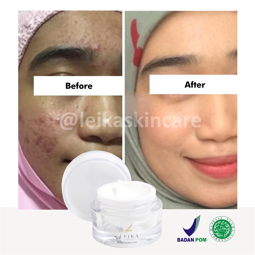 Penghilang jerawat wanita paling ampuh permanen leika skincare cream penghilang jerawat dan bekas jerawat BPOM Halal penghilang jerawat bruntusan batu bopeng obat penghilang jerawat paling ampuh original obat jerawat paling ampuh untuk wanita