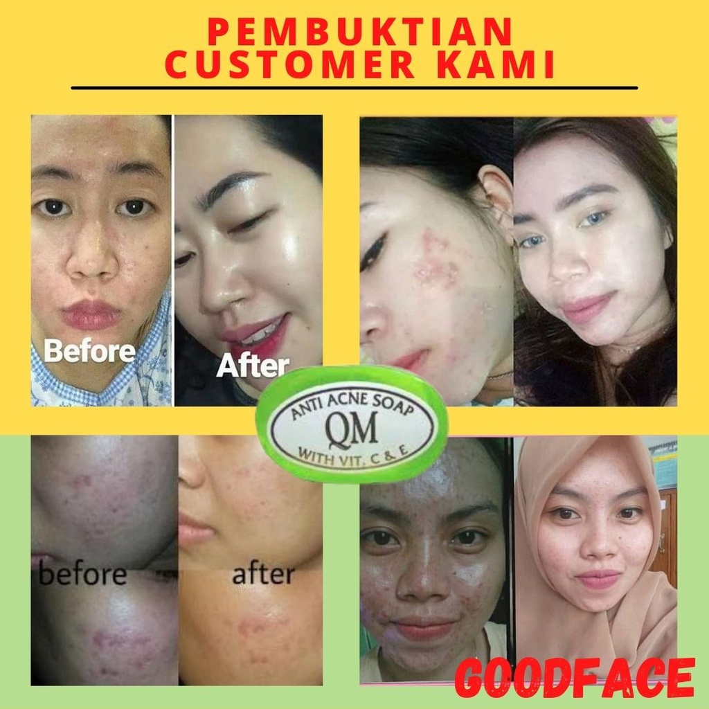 QM FACIAL SOAP FOR ACNE SKIN ORIGINAL BPOM-SABUN QM BPOM