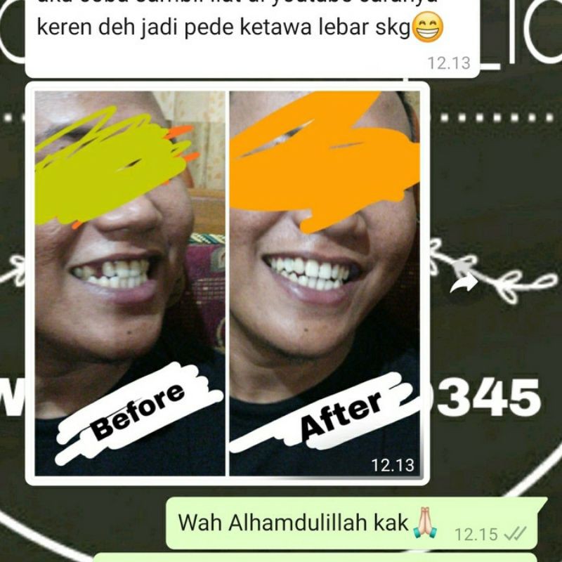 Ready stock Lem Gigi penambal gigi patah renggang ompong temporary tooth temptooth gingsul venner