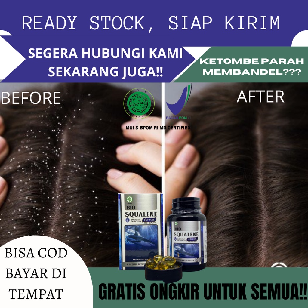 Obat Ketombe Membandel, Obat Anti Ketombe, Ketombe Gatal, Ketombe Kering, Ketombe Anak dan Dewasa, K