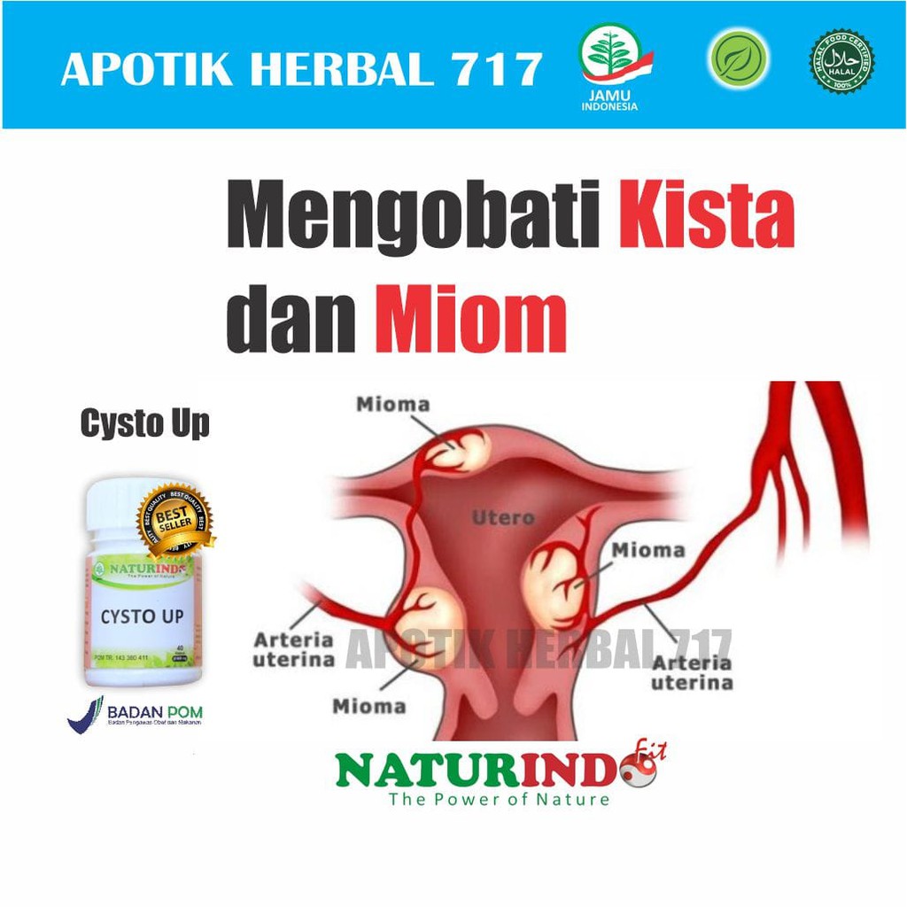 Obat Kista Miom Kista Bartholin Kista Coklat Kista Endometriosis Herbal Ampuh
