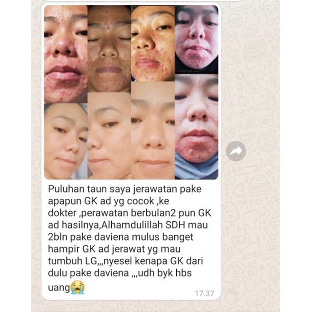 Paket Murah Acne Series Krim Wajah Berjerawat