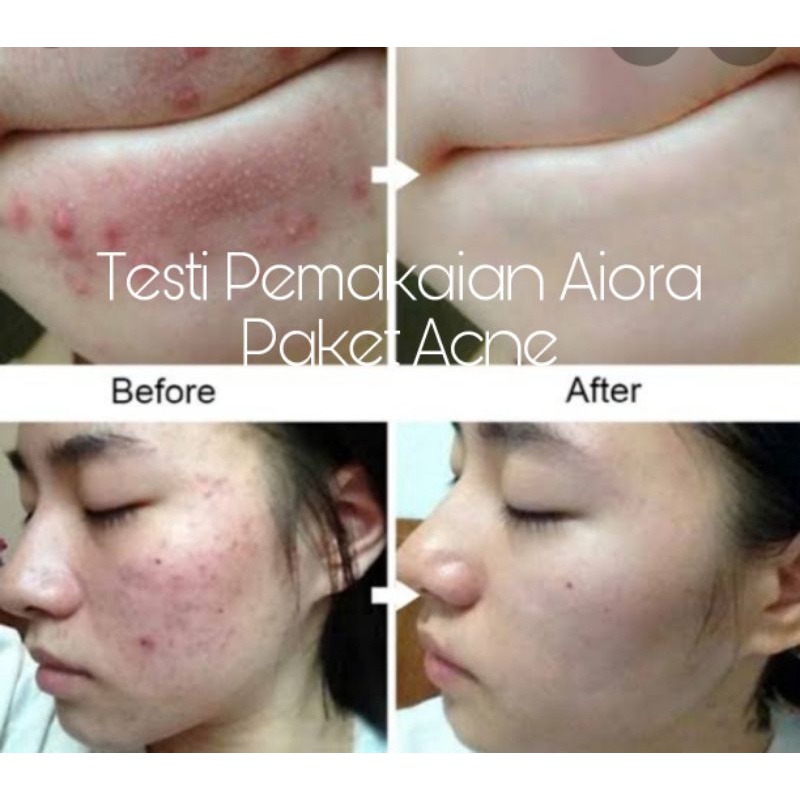 AIORA SKINCARE BPOM CREAM WAJAH PAKET GLOWING ACNE-4
