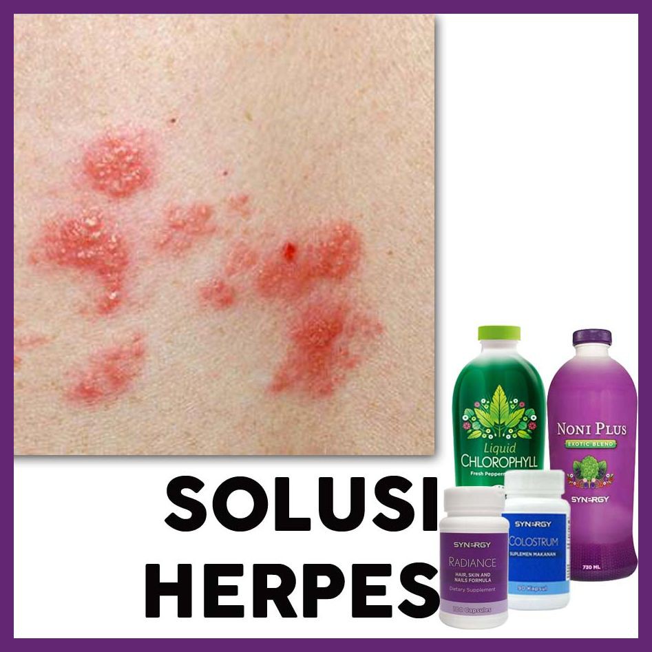 Obat Menyembuhkan Herpes / Dompo / Cacar Ular Kulit Kelamin Wanita