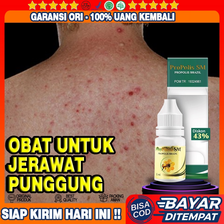 Obat Jerawat Punggung, Obat Penghilang Jerawat Punggung, Obat Oles Jerawat Punggung, Propolis SM