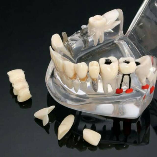 Dental study model caries impacted teeth crown bridge implan patung gigi