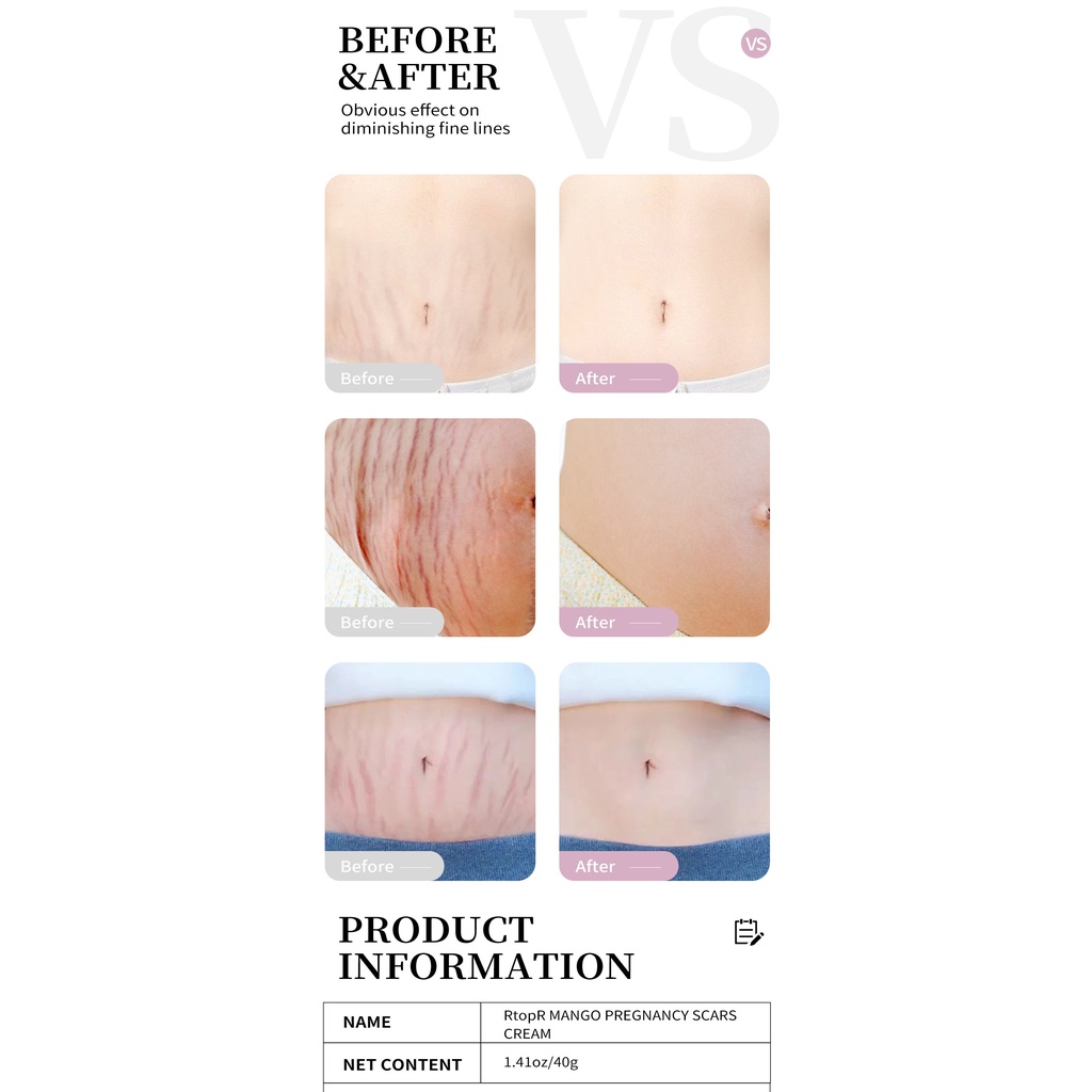 【asli】RtopR  Remove Pregnancy Scars Cream- Stretchmark Cream-Penghilang Strechmark-Perawatan Tubuh  Penghilang bekas luka ampuh