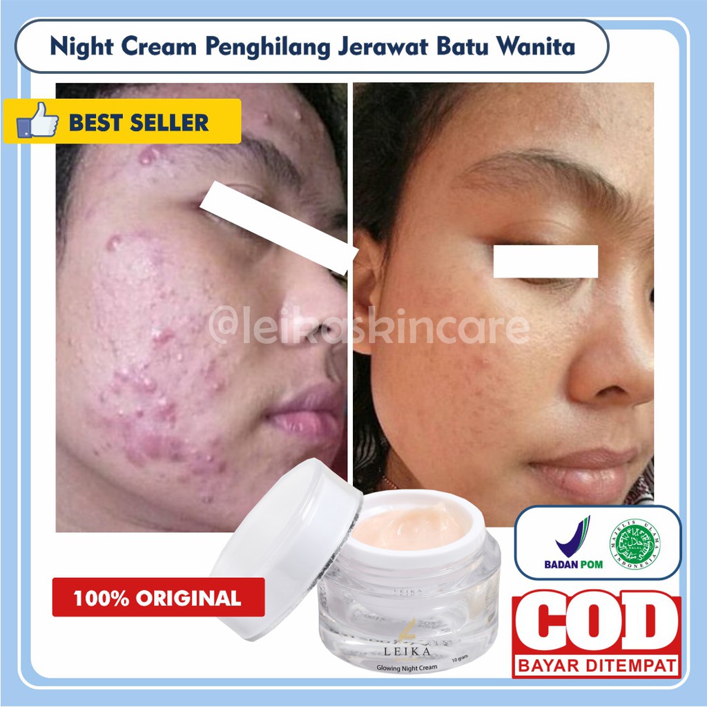 [KRIM MALAM] Penghilang Jerawat Batu Dan Bekas Jerawat Wanita Penghilang Jerawat Dan Bekas Jerawat P