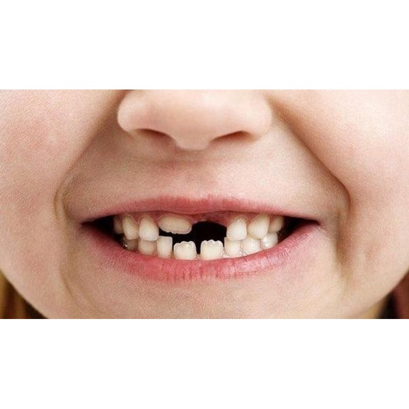 Temptooth 100 An Butir Harga Murah Paling Ekonomis Termurah Gigi Palsu Temporary Tooth Repair Shopee Indonesia