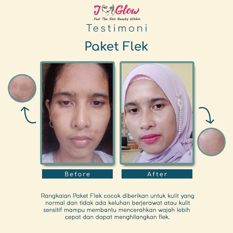 JGLOW SKINCARE PAKET FLEK WHITENING CREAM WAJAH UNTUK  FLEK-5