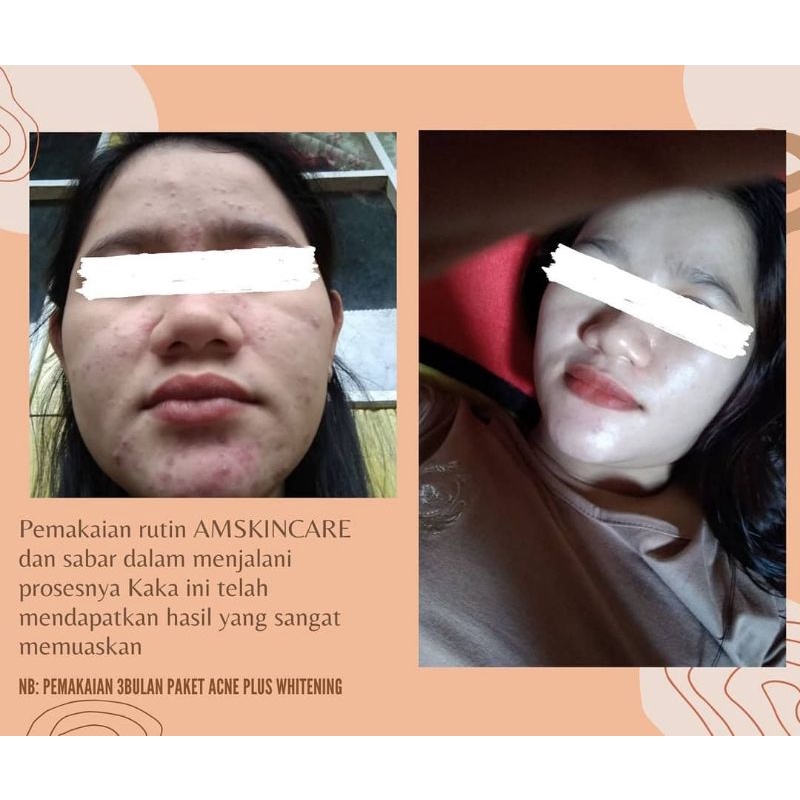 CREAM MALAM ACNE/JERAWAT BY AMSKINCARE | AMPUH USIR JERAWAT BANDEL BERUNTUSAN BOPENG