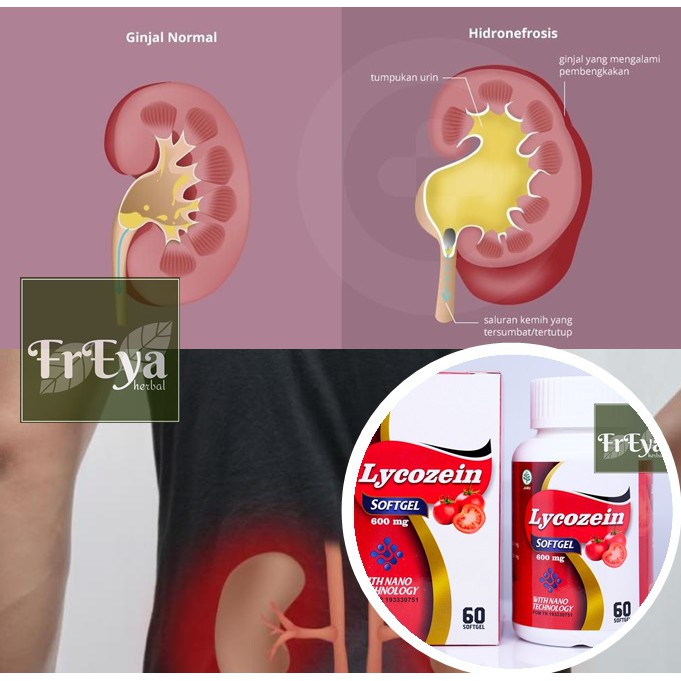 OBAT GINJAL BENGKAK, OBAT HERBAL HIDRONEFROSIS, OBAT GINJAL MEMBESAR (BISA COD)