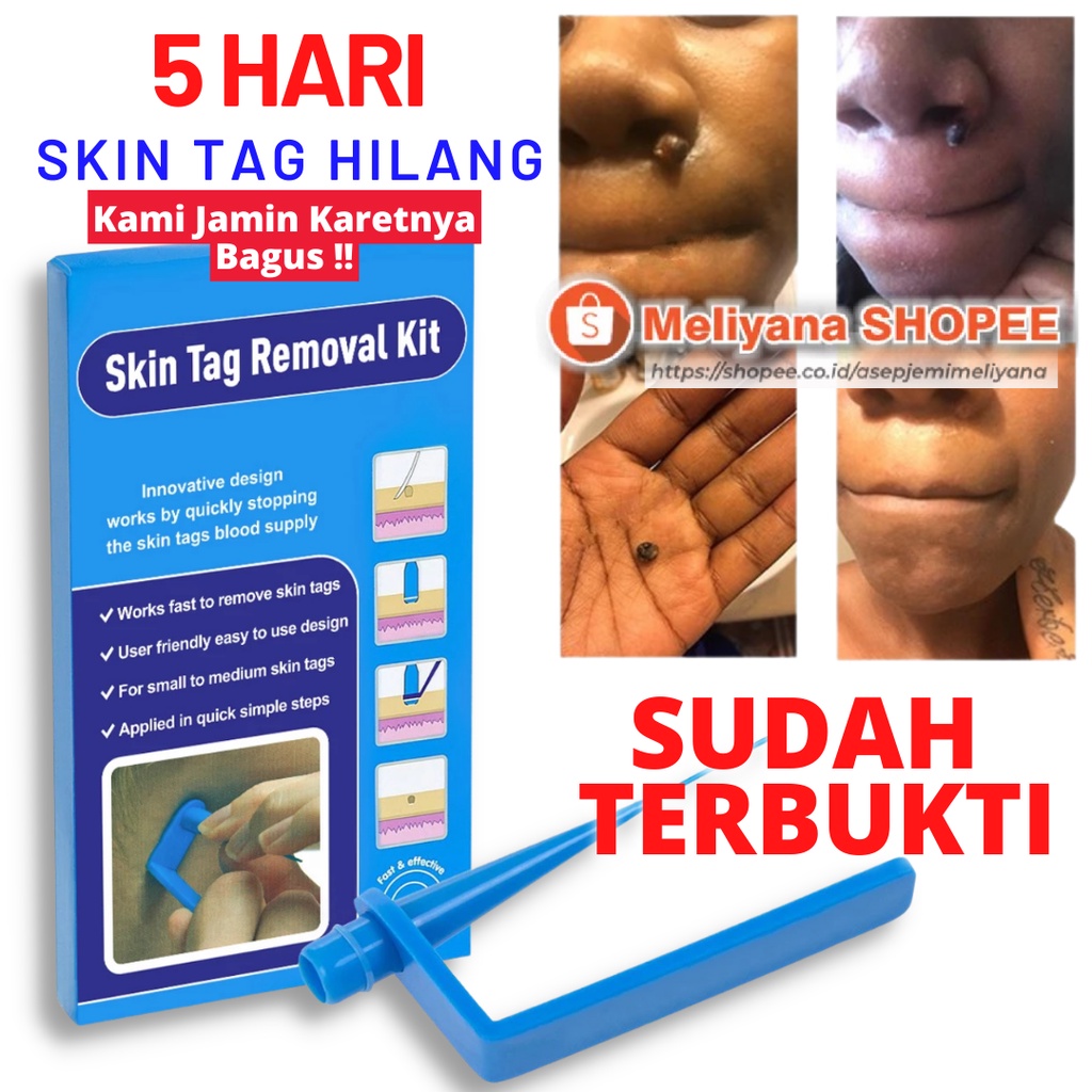 Obat Kutil Penghilang Tahi Lalat Skin Tag Mole Wart Remover Tools Kit