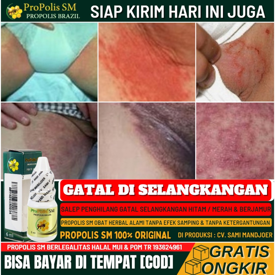 Salep Penghilang Gatal Selangkangan, Penghilang Selangkangan Hitam/Merah, Infeksi Jamur, Propolis SM