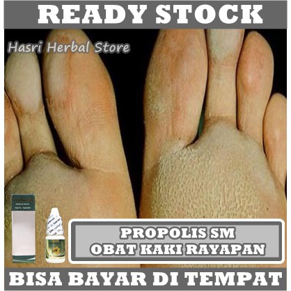 Obat Kaki Bolong Bolong 100% Alami, Obat Penghilang Kaki Rayapan, Obat Kaki Rayapan, Obat Telapak Kaki Rayapan, Obat Bau Kaki, Obat Tumit Pecah Pecah, Obat Rorombeheun, Obat Kaki Bolong &amp; Bau, Obat Korodok Dengan Propolis SM 100% Original