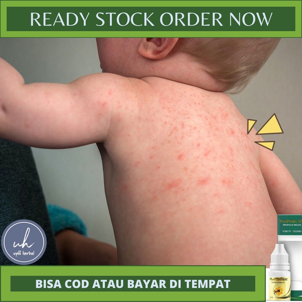 OBAT BIANG KERINGAT - OBAT OLES HERBAL BIANG KERINGAT,MILIARIA RUBRA,BIANG KERINGAT ANAK & DEWASA,BI