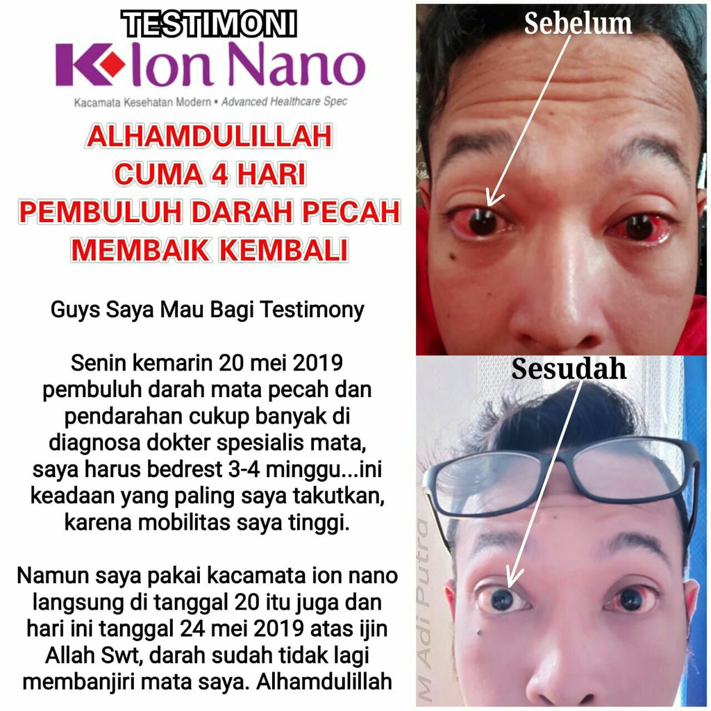 Kacamata terapi Ion Nano/Kacamata mengandung Ion - Kacamata Kesehatan, membantu mengatasi mata minus