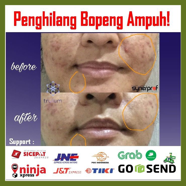CREAM BOPENG / BOPENG JERAWAT / BOPENG JERAWAT TRULUM AMPUH TERBAIK