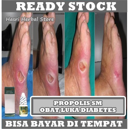 Obat Luka Diabetes Melitus Basah / Kering, Obat Pengering Luka Diabetes, Obat Tetes Infeksi Luka Diabetes, Obat Luka Diabetes Bernanah, Obat Luka Gangren, Obat Luka Diabetes Di Kaki, Obat Luka Diabetes Resep Dokter Dengan Propolis SM 100% ASLI ORIGINAL