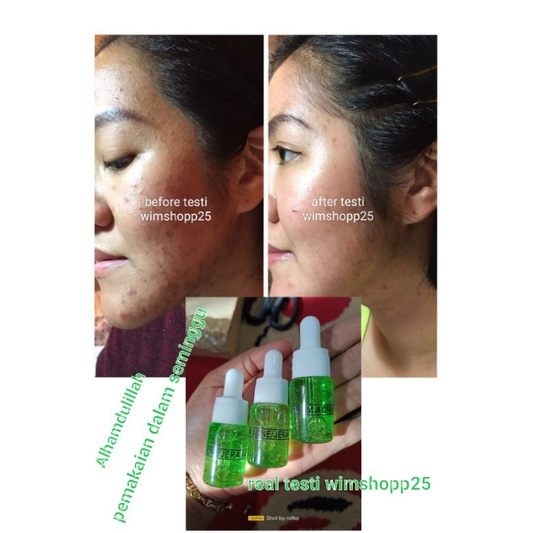 SERUM ACNE/JERAWAT NEW AND FRESH 10ML