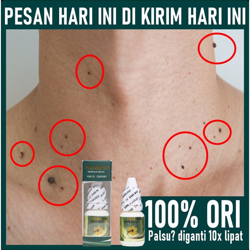 Penghilang kutil di leher - Penghilang papiloma di leher - Obat Papiloma di Leher - Perontok Kutil -