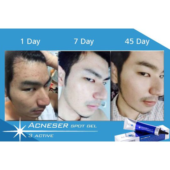 [ FREE GIFT ] ACNOC Acneser Spot Gel 15G Obat Jerawat Ampuh