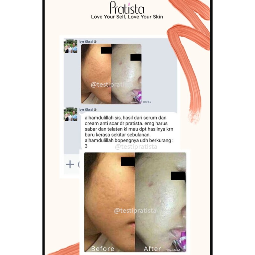 Pratista Centella Enrich Cream Untuk Bopeng Pada Wajah