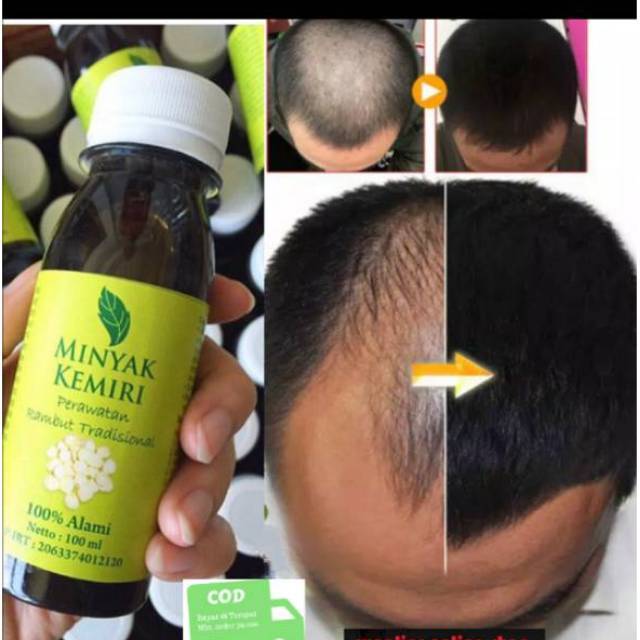 Jual Penumbuh Penyubur Rambut Anti Botak Minyak Kemiri Original Vitamin Rambut Penumbuh Rambut Bayi Indonesia Shopee Indonesia