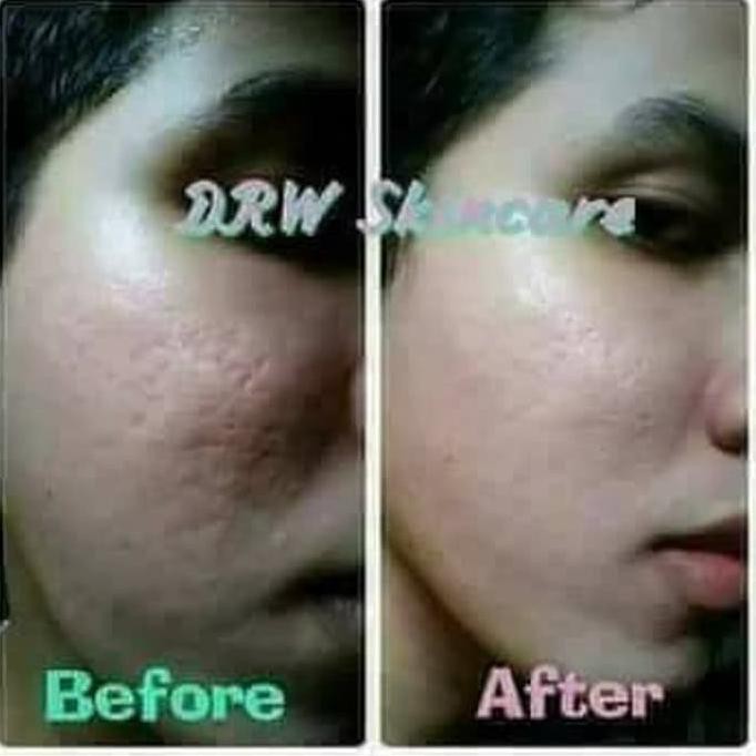 Unik Serum Scar Drw Skincare Untuk Bekas Jerawat Bopeng 31 Agustus Shopee Indonesia