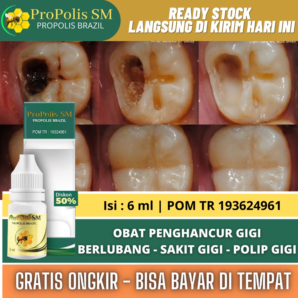 Obat Sakit Gigi Berlubang / Gigi Bolong - Obat Nyeri gusi - Obat Gigi Berlubang - Obat Gigi Berlubang Tanpa Di Tambal - Obat Nyeri Gigi Berlubang - Obat Gusi Bengkak Nyut Nyutan - Obat Gusi Berdarah