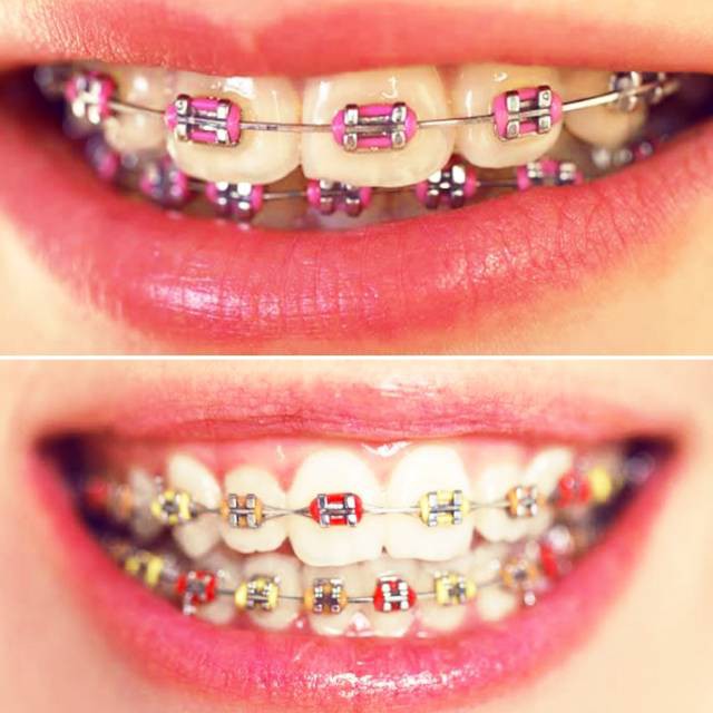 Behel Kawat Gigi Lepas Pasang Fashion Aneka Motif Cantik L06 PGD